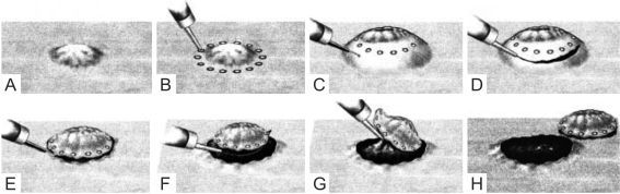 Endoskopische Submukosa-Disektion (nach N. Yahagi et al., Dig. Endosc, 2004)